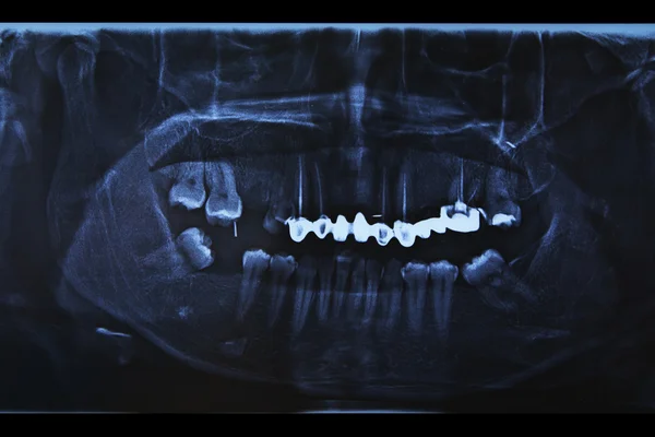 Рентгеновское сканирование человеческих зубов — стоковое фото