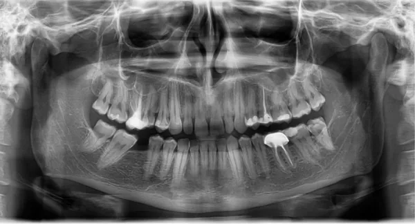Raio-X dental panorâmico — Fotografia de Stock