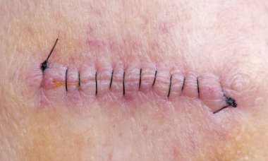 Stitches After Skin Cancer Removal clipart