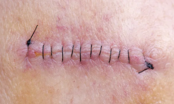 Stitches After Skin Cancer Removal — Stock Photo, Image