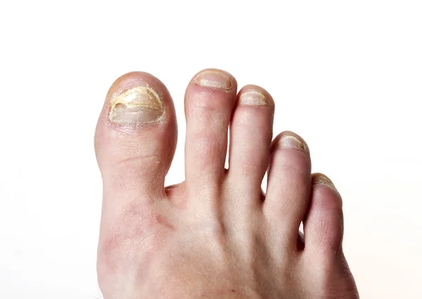 Fungo dell'unghia del piede — Foto Stock