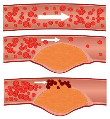 Cholesterol plaque in artery (atherosclerosis) clipart