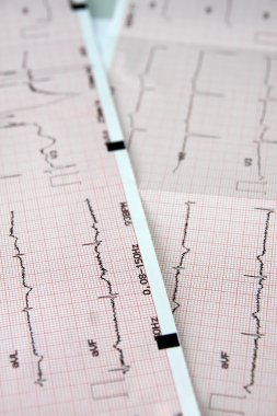 EKG diyagramı