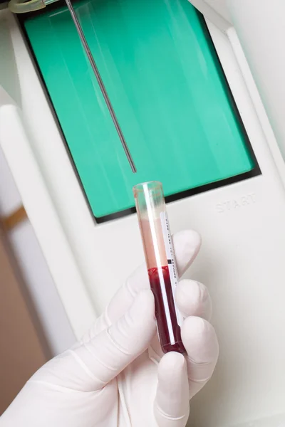 Mulher executa teste hematológico . — Fotografia de Stock