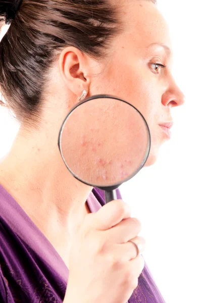 Problèmes d'acné — Photo