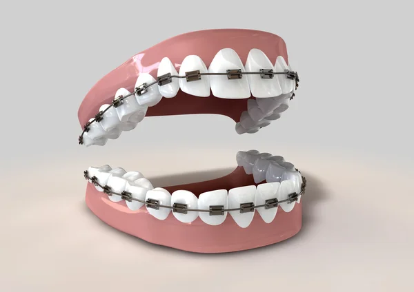 Зубы, оснащенные брекетами — стоковое фото