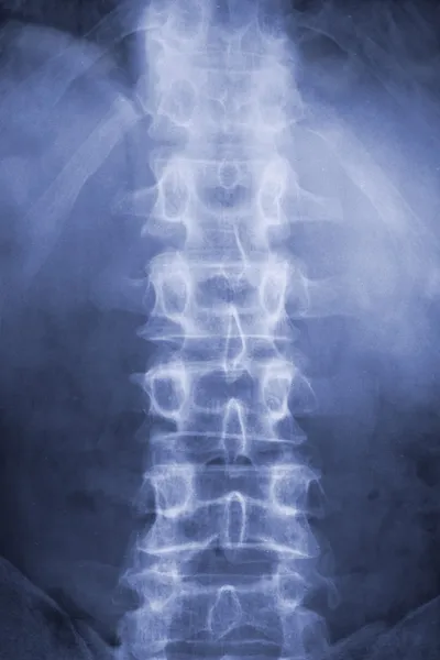 Wirbelsäule im Röntgenbild — Stockfoto