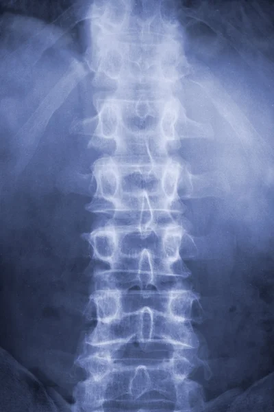 Рентген позвоночника Стоковое Изображение