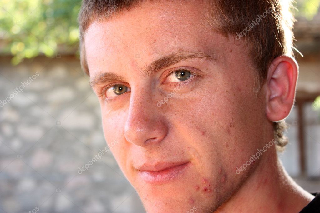 Teenager with pimples on his face close up — Stock Photo © ademdemir ...