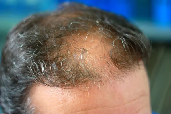 Cabeza masculina con síntomas de pérdida de cabello en la parte frontal —  Fotos de Stock