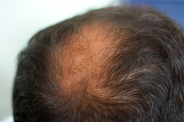 Cabeza masculina con síntomas de pérdida de cabello en la espalda —  Fotos de Stock