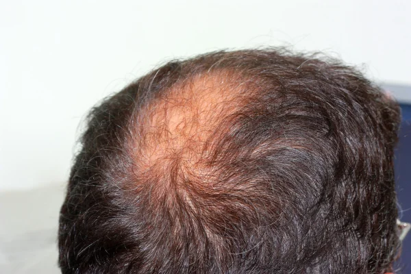 Ανδρικό κεφάλι με μαλλιά απώλεια συμπτώματα πίσω πλευρά — Φωτογραφία Αρχείου