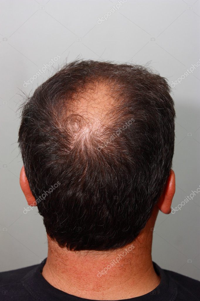 Male head with hair loss symptoms back side Stock Photo by ©ademdemir  12014921