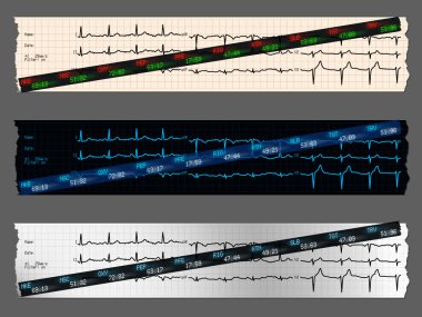 Borsa senedi ile EKG grafiği