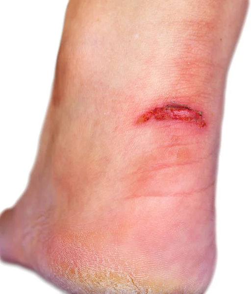 Открытая рана на каблуке — стоковое фото