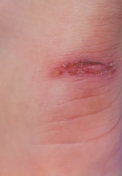 Open wound in heel — Stock Photo, Image