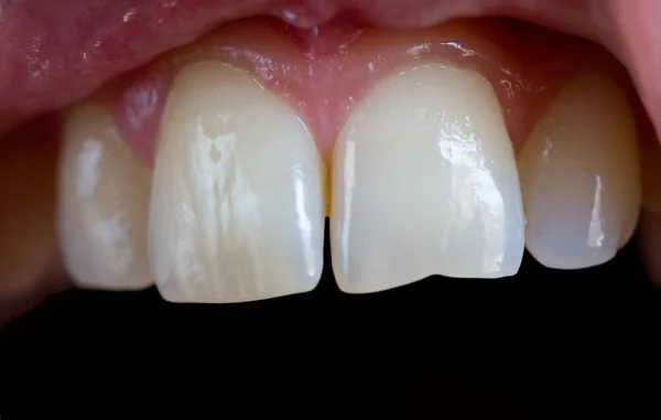 Caucásico hombre superior dientes — Foto de Stock