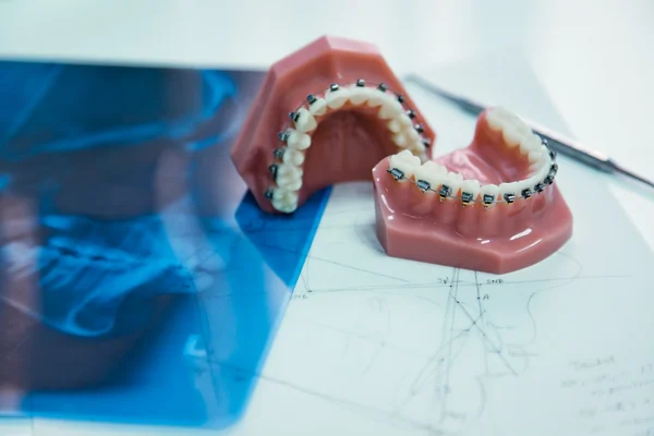 Ортодонтия — стоковое фото
