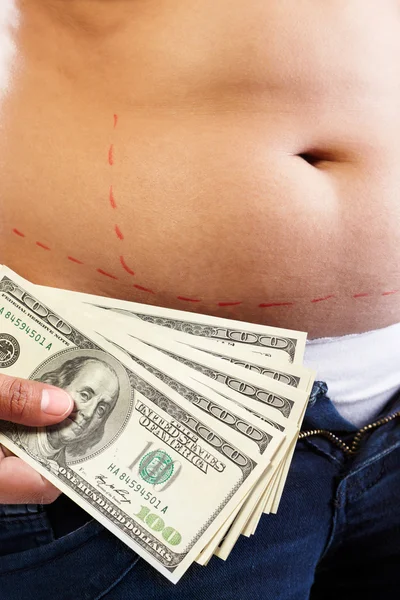 Cost of liposuction — Stock Photo, Image
