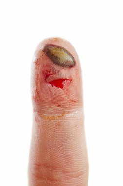 Wound finger clipart