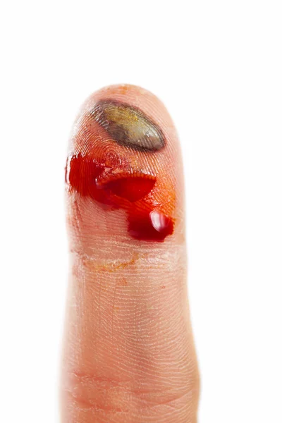 Πληγή δάχτυλο — Φωτογραφία Αρχείου