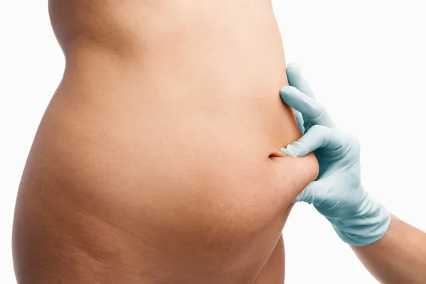 Žena střední část tlačí před liposukcí — Stock fotografie