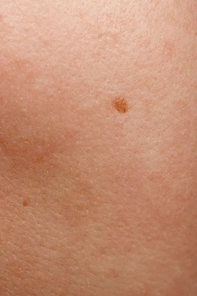 Close-up of human skin and mole — Stock Photo, Image
