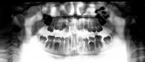 Raios-X do osso da mandíbula humana — Fotografia de Stock