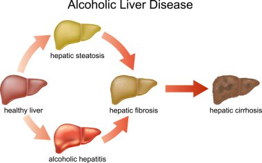 Alcoholic Liver Disease. clipart