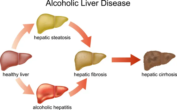 Enfermedad hepática alcohólica . — Vector de stock
