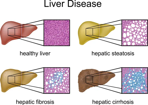 Liver Disease with micrograph Stock Illustration