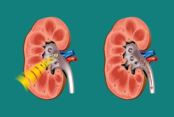 Lithotripsy in kidney stones — Stock Vector