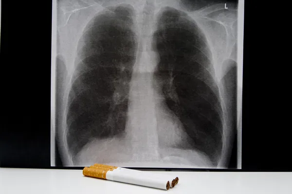 stock image Image of a smoker lung