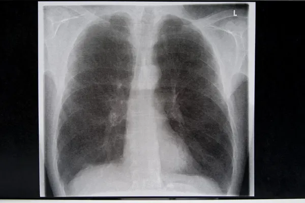 Dohányos tüdő röntgen - A belgyógyászat alapjai 1. | Digitális Tankönyvtár