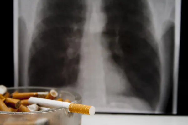 Egy dohányos tüdő röntgen képe Stock Kép