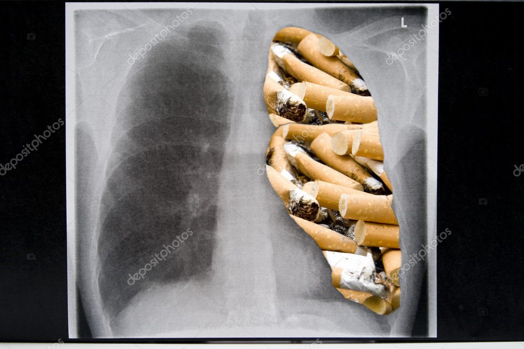 dohányos tüdő modell