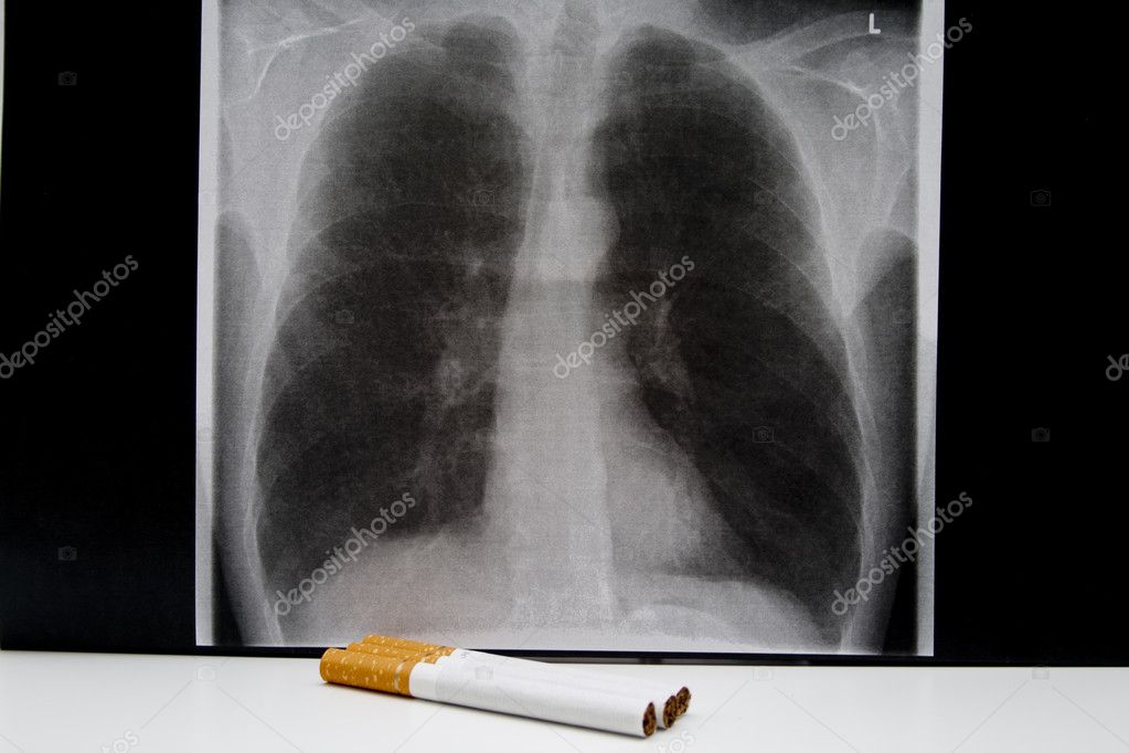 Poumon De Fumeur Images Libres De Droit Photos De Poumon De Fumeur Depositphotos