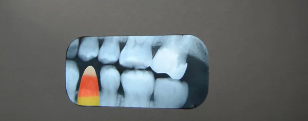 stock image Xray of candy in teeth