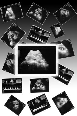 Baby on an ultrasound image clipart