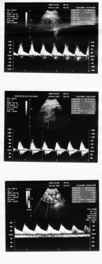 Çocuk resim ultrason