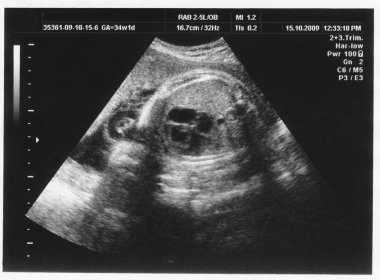 Çocuk resim ultrason