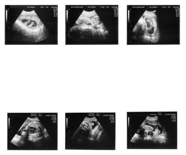 Baby on ultrasound image clipart