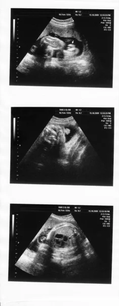 Niño en la imagen ultrasonido — Foto de Stock
