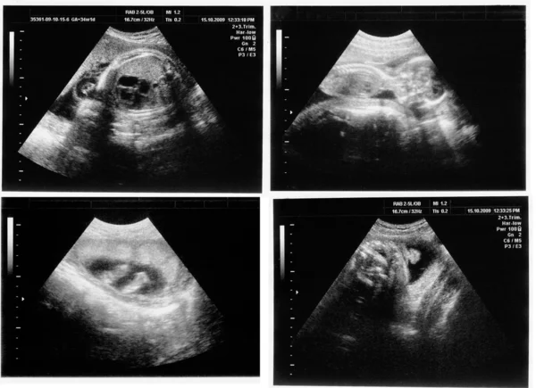Bambino nell'immagine ultrasuoni — Foto Stock