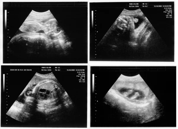 Child in the picture ultrasound — Stock Photo, Image