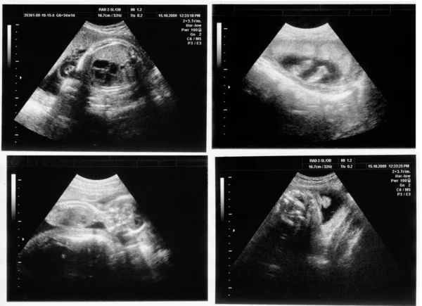 A kép ultrahang gyermek — Stock Fotó