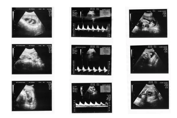 stock image Child in the picture ultrasound
