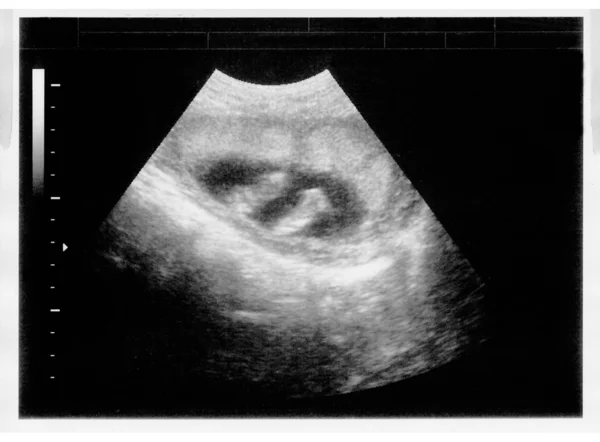 Copil în imagine ultrasunete — Fotografie, imagine de stoc