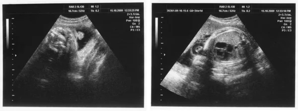 Child in the picture ultrasound — Stock Photo, Image