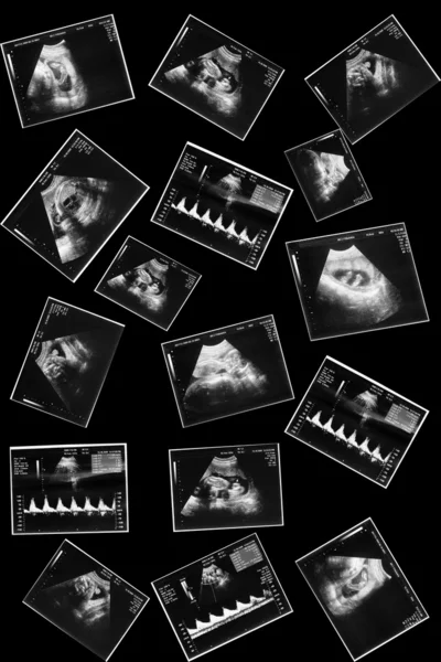 超音波画像の赤ちゃん — ストック写真
